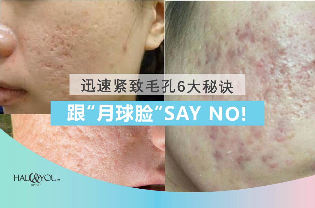 Halo & You | 迅速紧致毛孔6大秘诀,跟“月球脸”SAY NO!