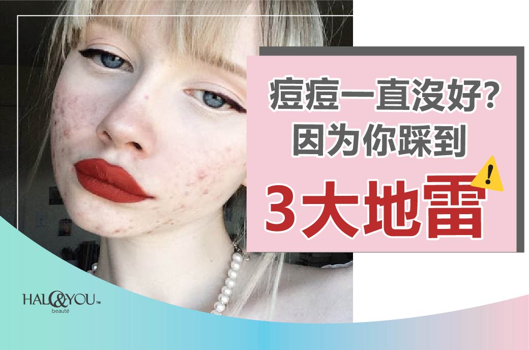 Halo & You | 痘痘一直沒好?因为你踩到3大地雷