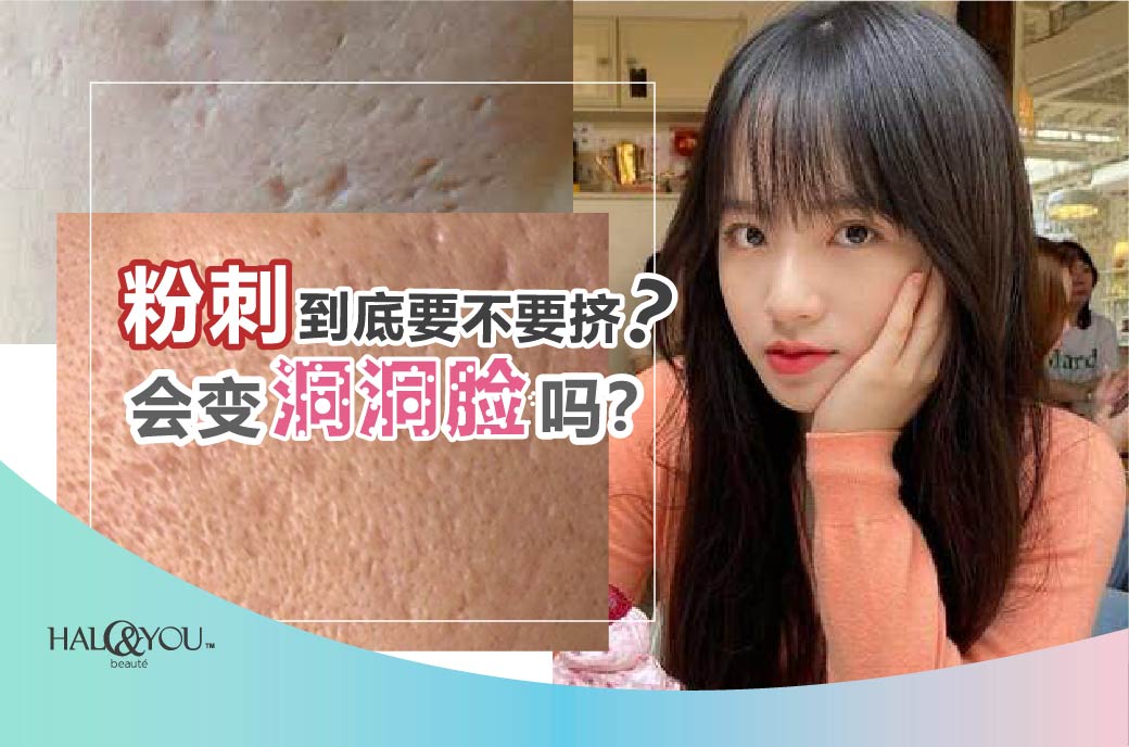 Halo & You | 粉刺到底要不要挤?会变洞洞脸吗?