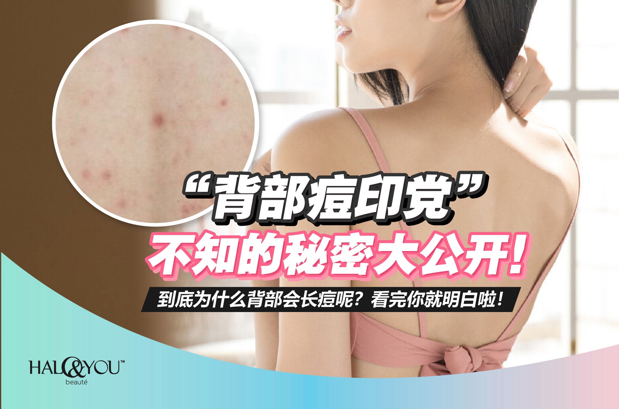 「背部痘印党」不知的秘密大公开!【Halo & You】