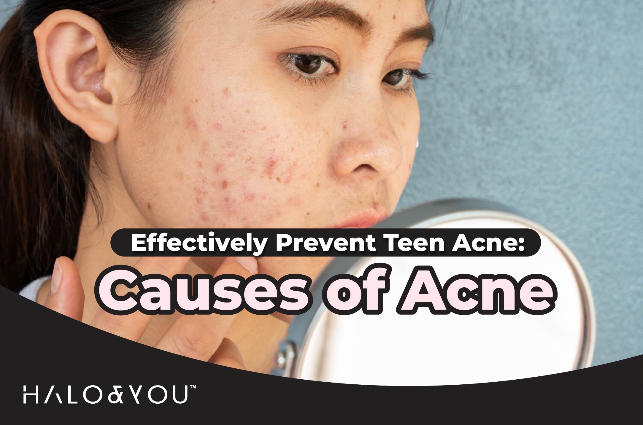causes of acne halo and you trio bio deep cleansing facial mask
