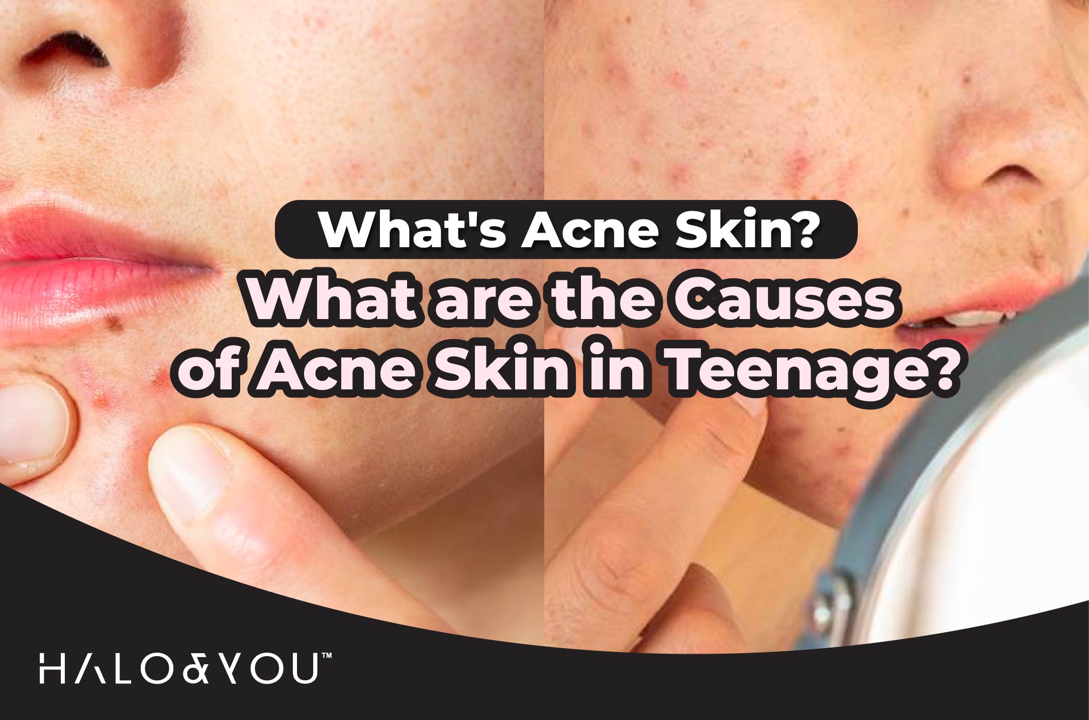 teenage's acne skin halo and you trio bio deep cleansing facial mask