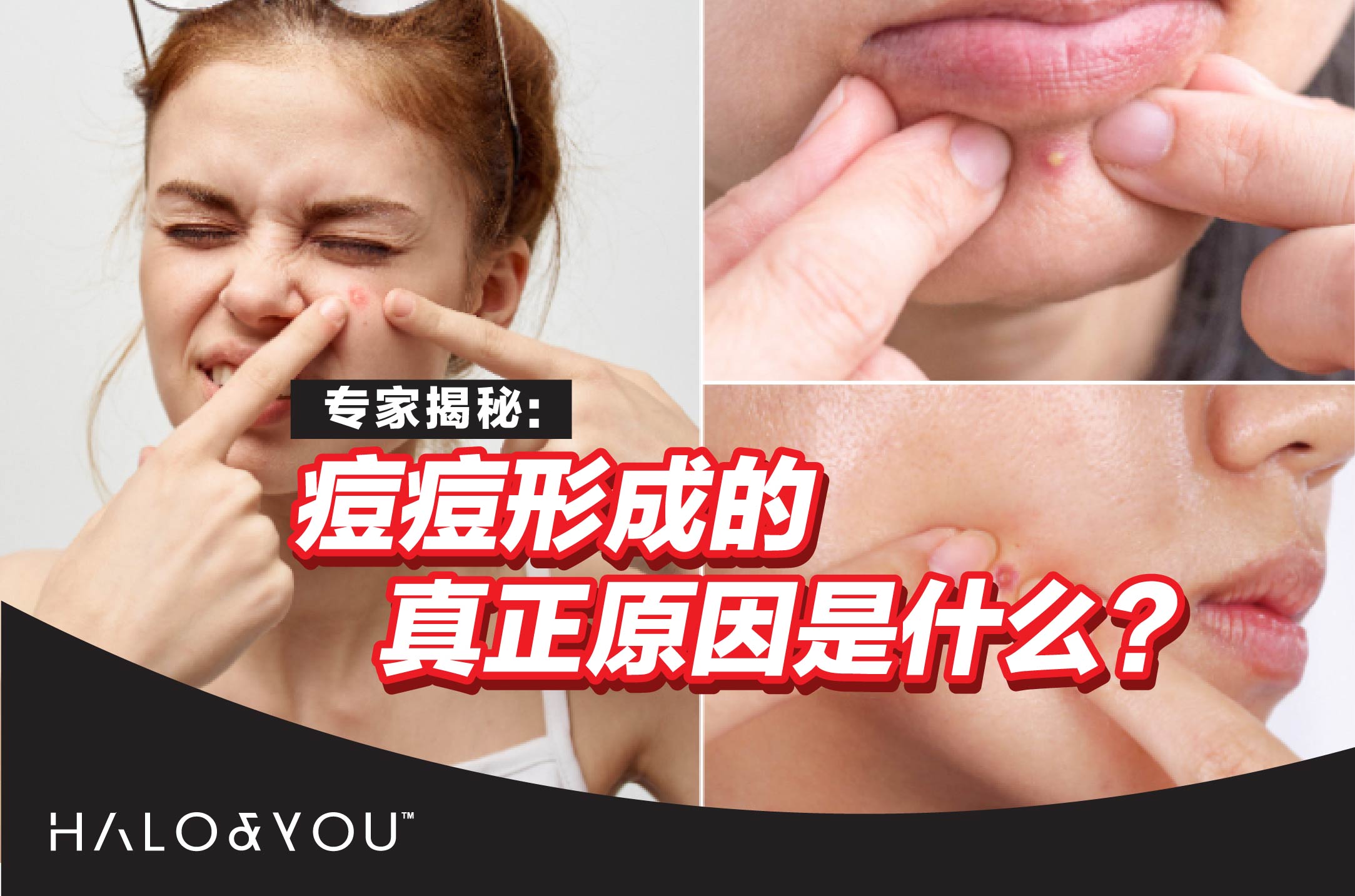 专家揭秘:痘痘形成的真正原因是什么?
