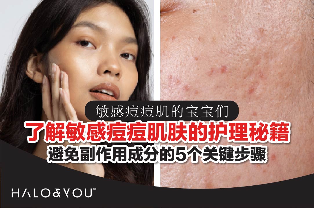 了解敏感痘痘肌肤的护理秘籍:避免副作用成分的5个关键步骤