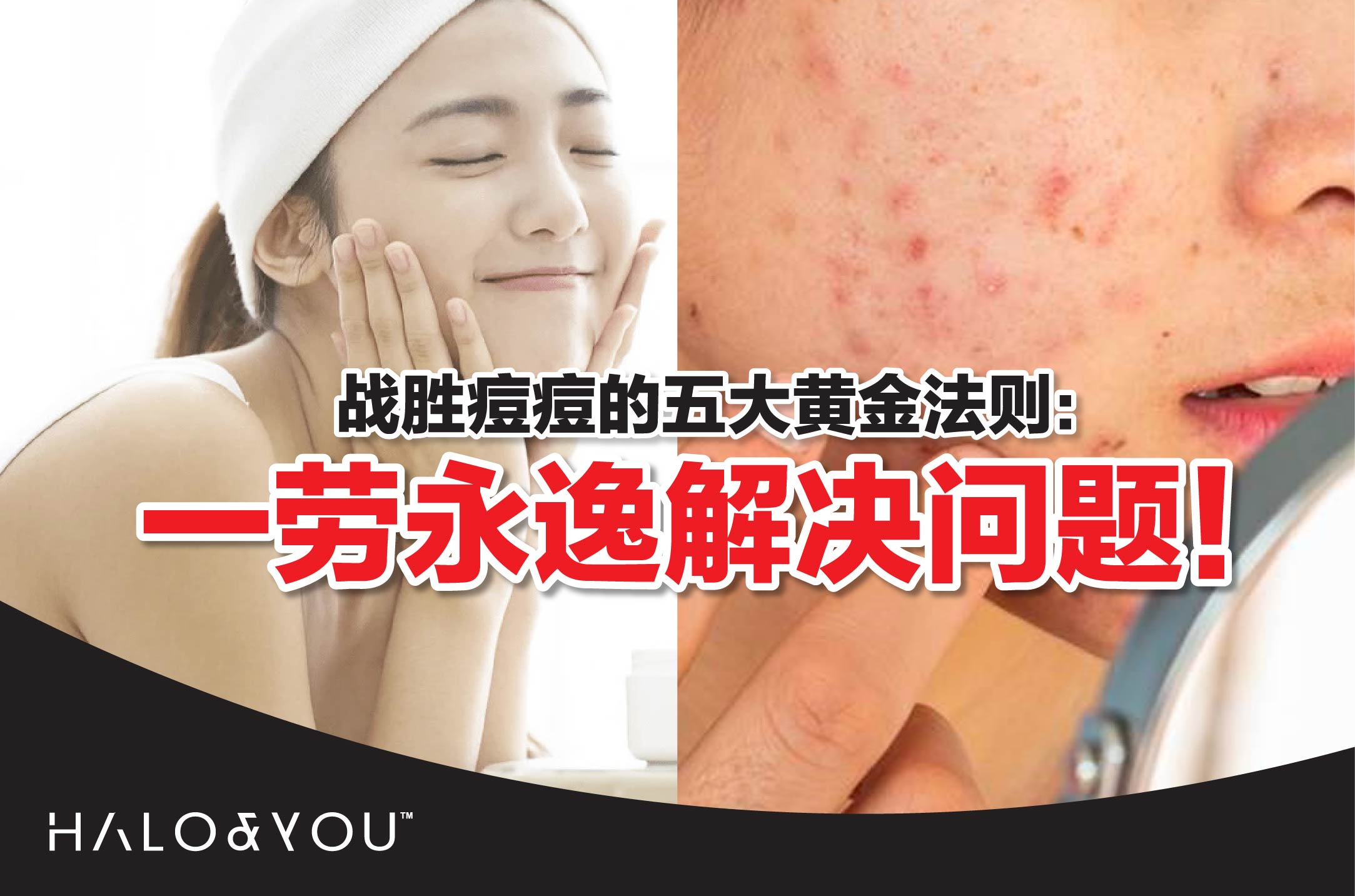 战胜痘痘的五大黄金法则:一劳永逸解决问题!