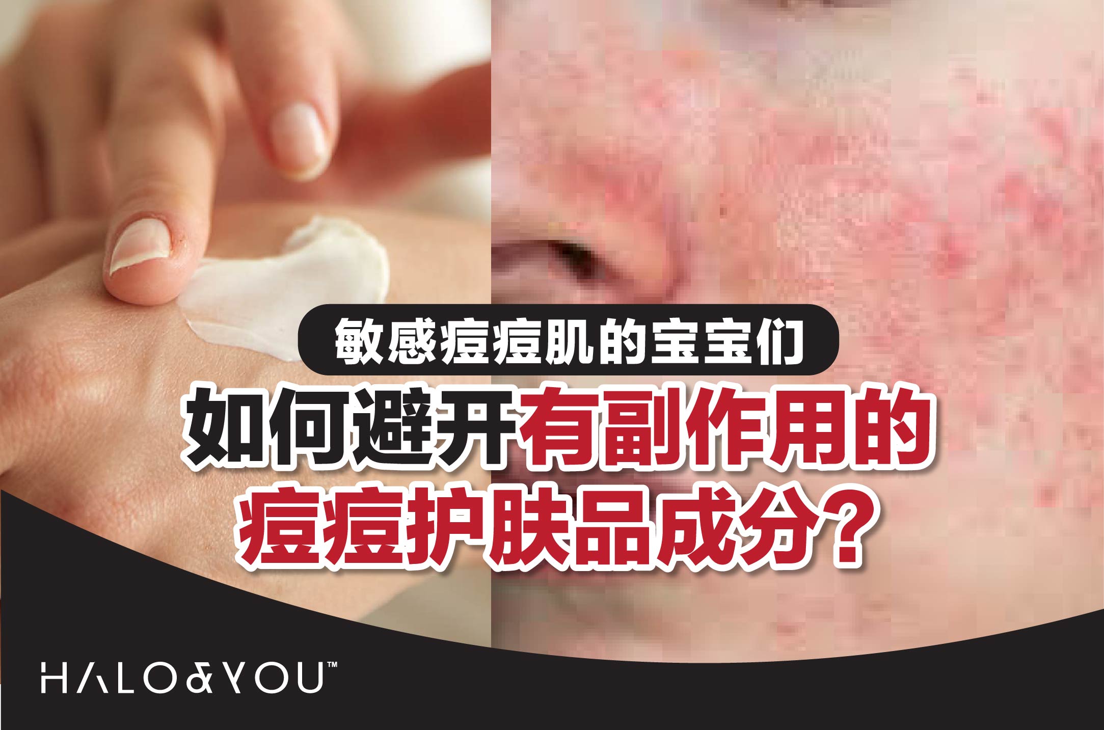 敏感痘痘肌的宝宝们,如何避开有副作用的痘痘护肤品成分?