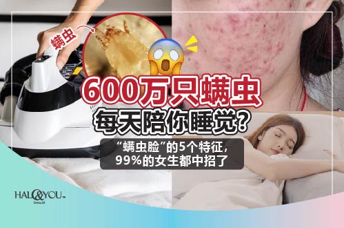 Halo & You | 600万只螨虫每天陪你睡觉？ “螨虫脸”的5个特征，99%的女生都中招了