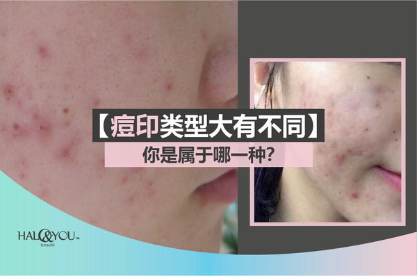 痘印类型大有不同，你是属于哪一种？ 原来不同的痘印，应对的方法也不一样